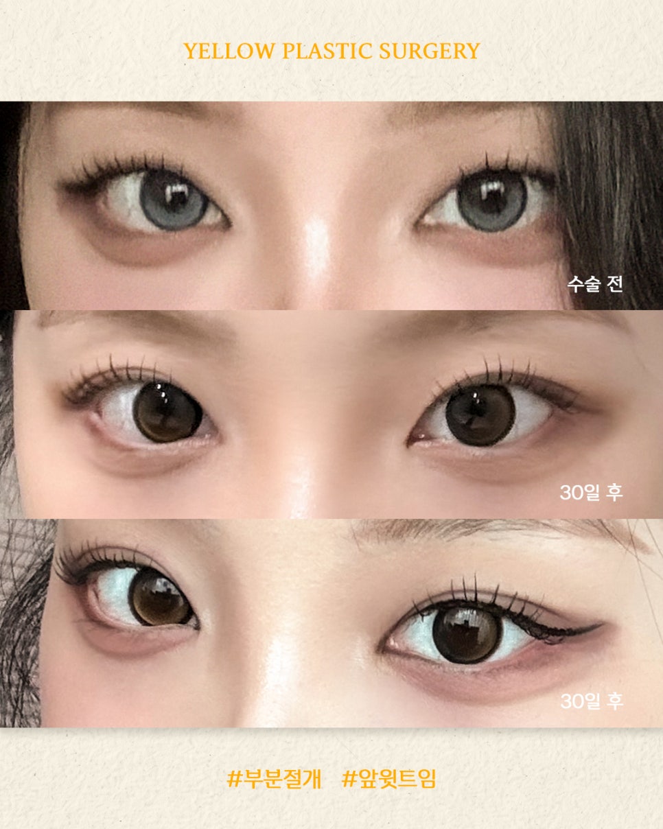 [ 강남역 옐로우성형외과 / 눈성형 ] 부분절개 + 앞윗트임 관련 이미지 1