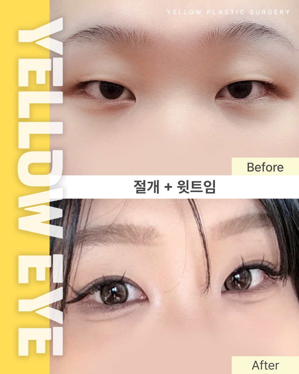 [ Gangnam Station Yellow Plastic Surgery / Eye Surgery ] Incision + Upper Eyelid Widening image 1