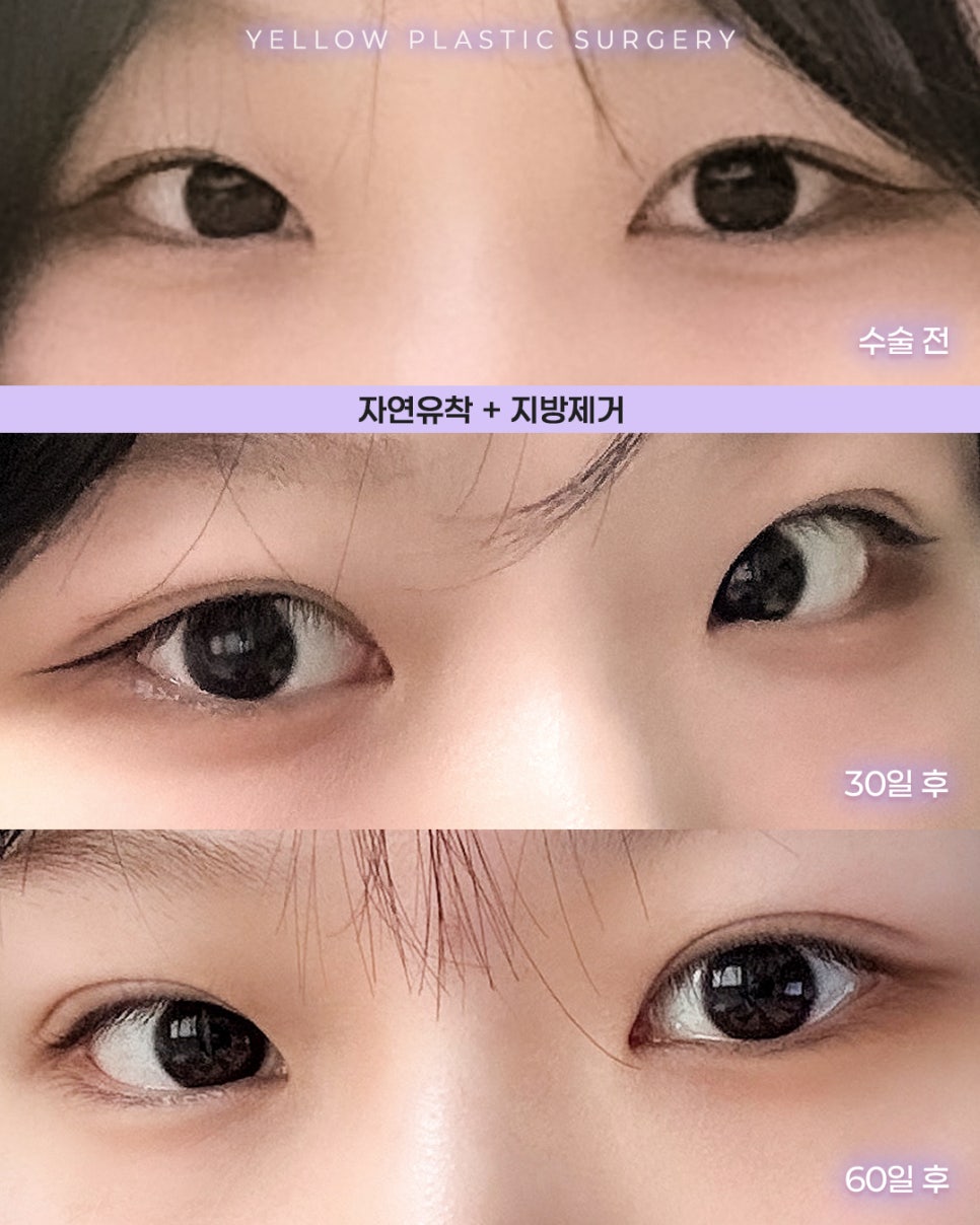 [ Gangnam Station Yellow Plastic Surgery / Eye Surgery ] Natural Adhesion + Fat Removal image 1