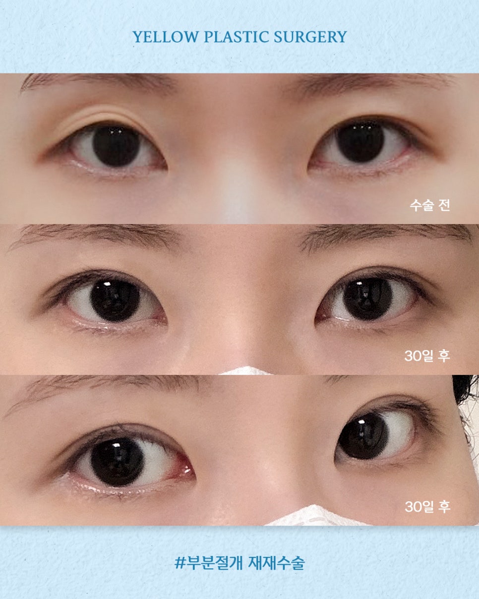 [ Gangnam Station Yellow Plastic Surgery / Eye Surgery ] Partial-Incision Second Revision Surgery image 1