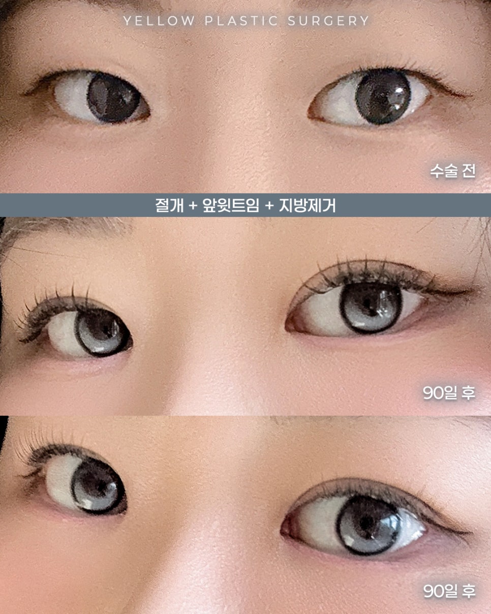 [ 강남역 옐로우성형외과 / 눈성형 ] 절개 + 앞윗트임 + 지방제거 관련 이미지 1