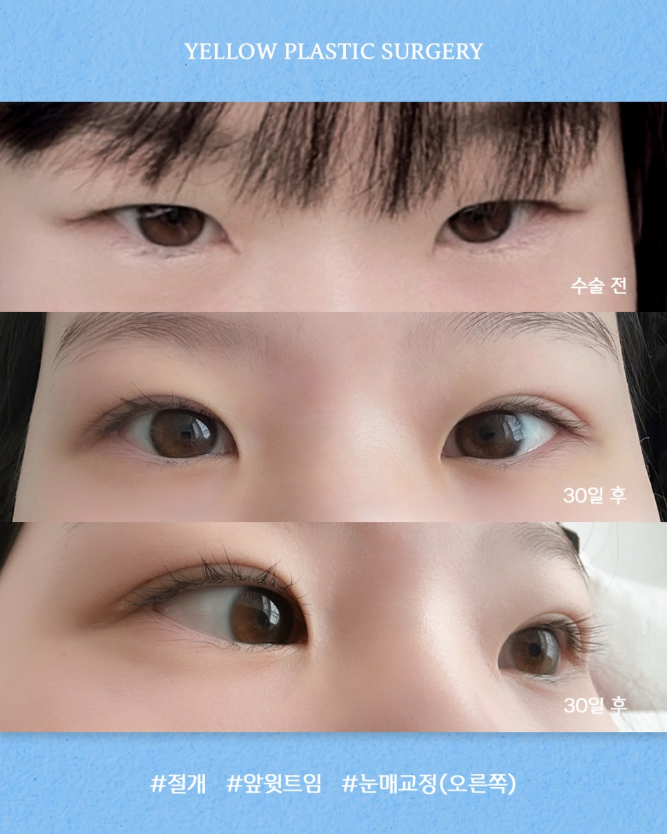 [ 강남역 옐로우성형외과 / 눈성형 ] 절개 + 앞윗트임 +눈매교정(오른쪽) 관련 이미지 1