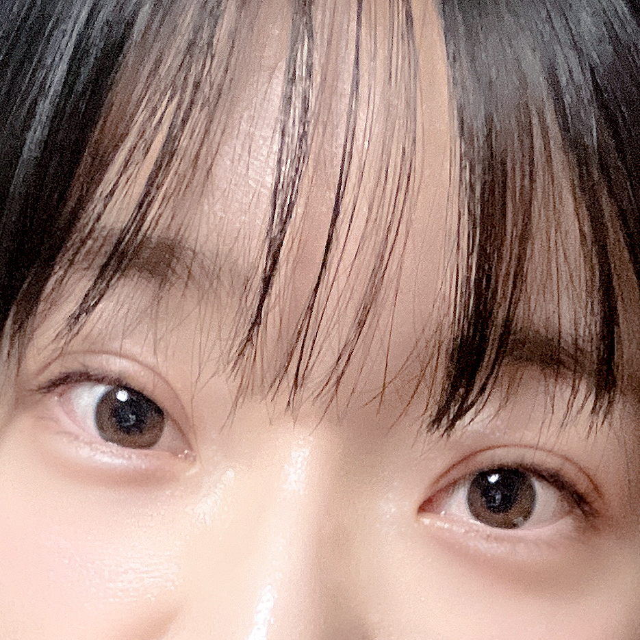 [Gangnam Station Yellow Plastic Surgery / Eye Surgery] Seven-Month Review After First Partial Incision Surgery: Improvement in Uneven Eyes image 9