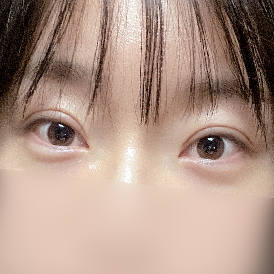 [Gangnam Station Yellow Plastic Surgery / Eye Surgery] Seven-Month Review After First Partial Incision Surgery: Improvement in Uneven Eyes image 7