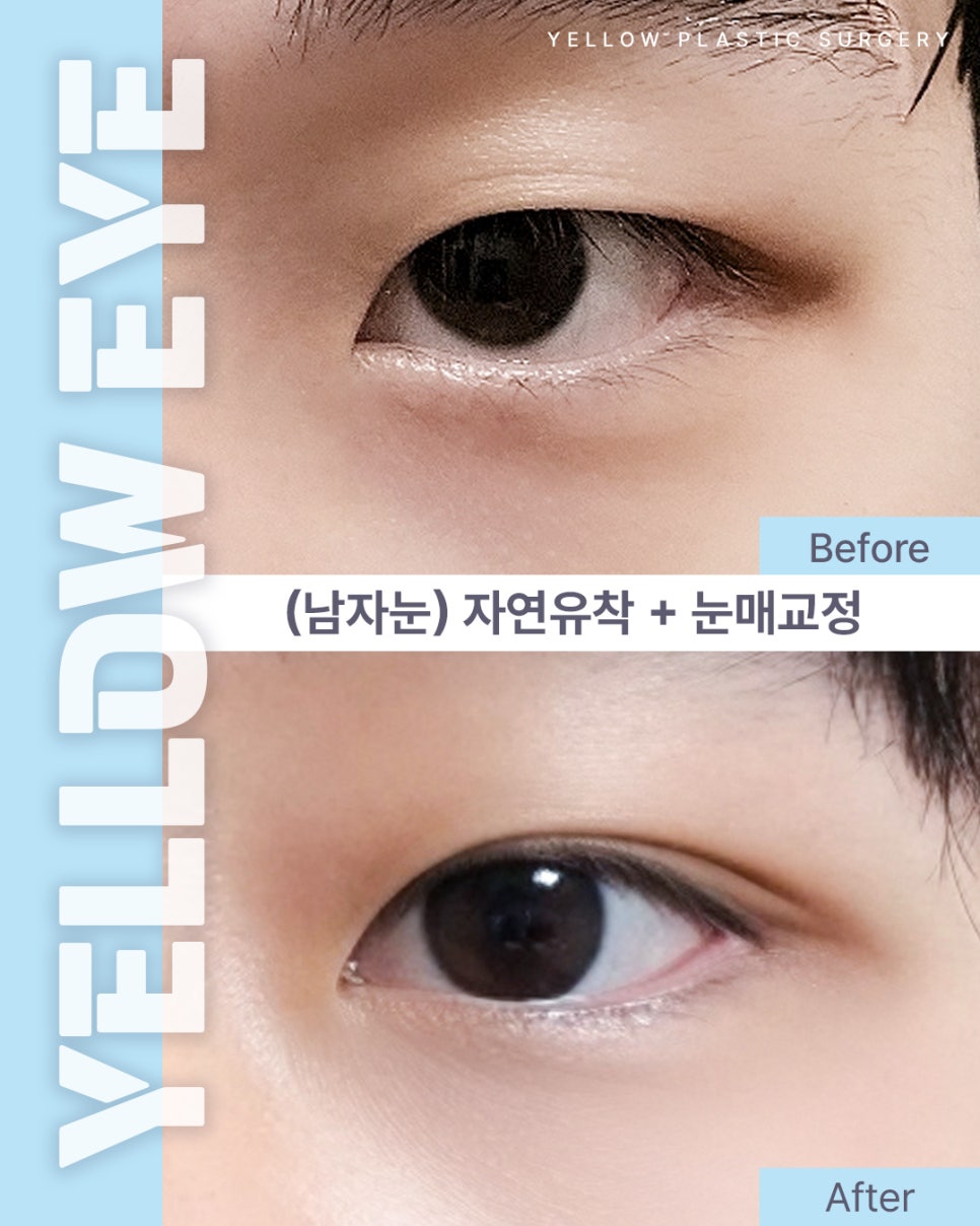 [ 강남역 옐로우성형외과 / 눈성형 ] (남자눈) 자연유착 + 눈매교정 관련 이미지 1