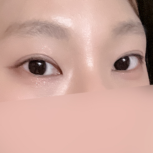 [ 강남역 옐로우성형외과 / 눈성형 ] 부분절개 재수술 후기 관련 이미지 8