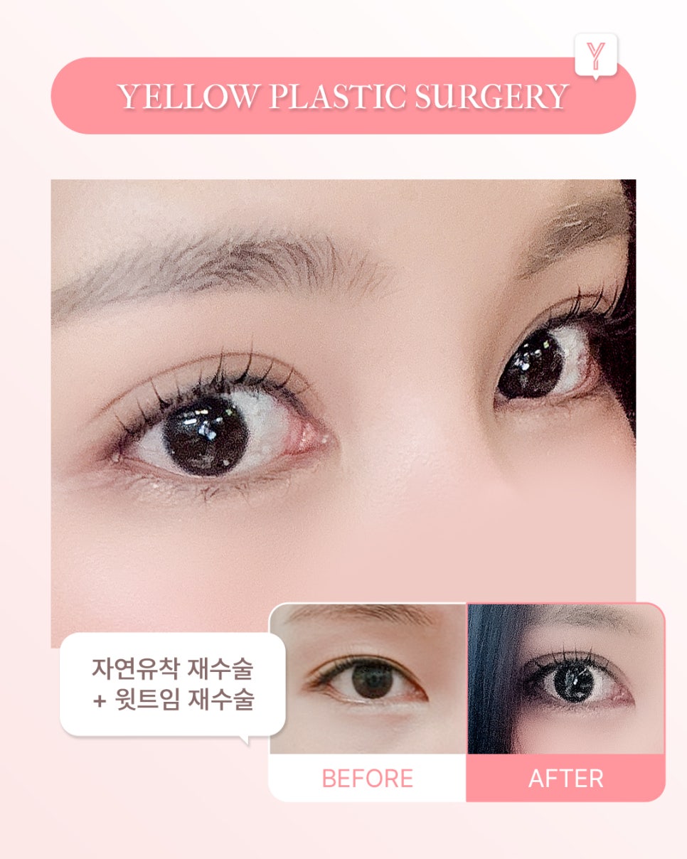 [ 강남역 옐로우성형외과 / 눈성형 ] 자연유착 재수술 + 윗트임 재수술 관련 이미지 1