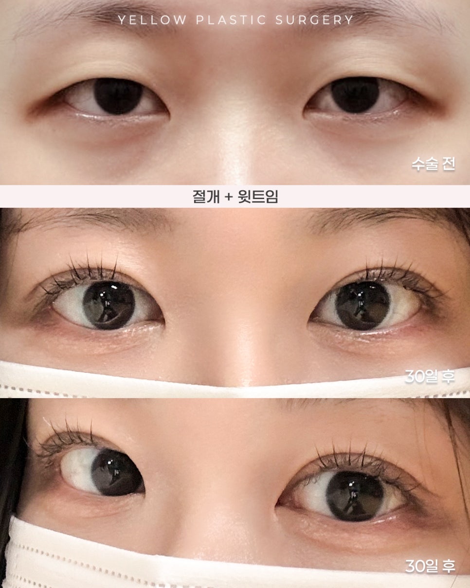 [Gangnam Station Yellow Plastic Surgery Clinic / Eye Surgery] Incisional Double Eyelid Surgery + Upper Canthoplasty image 1