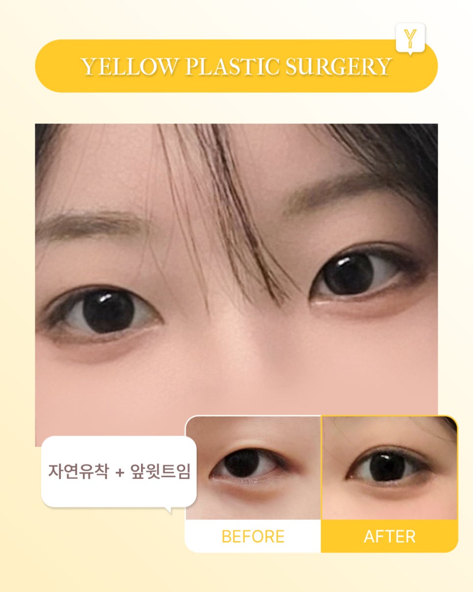 [ Gangnam Station Yellow Plastic Surgery / Eye Surgery ] Natural Adhesion + Upper Medial Canthoplasty image 1