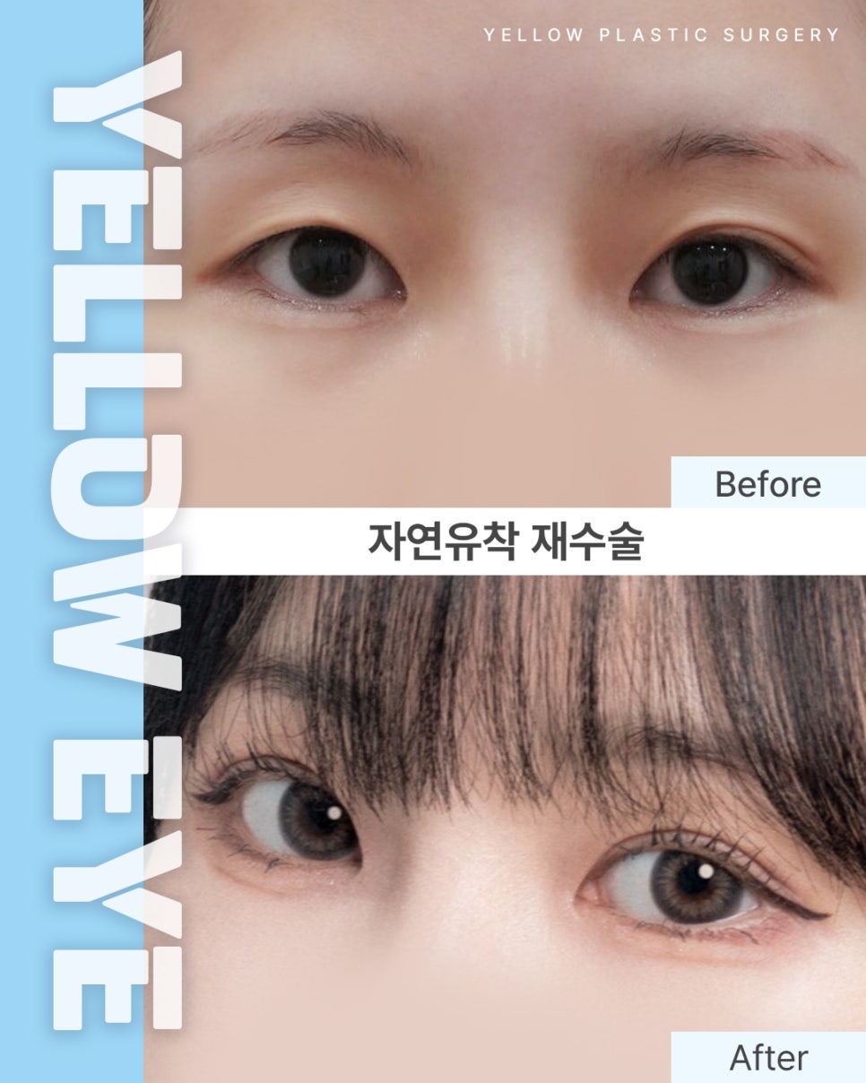 [ 강남역 옐로우성형외과 / 눈성형 ] 자연유착 재수술 관련 이미지 1