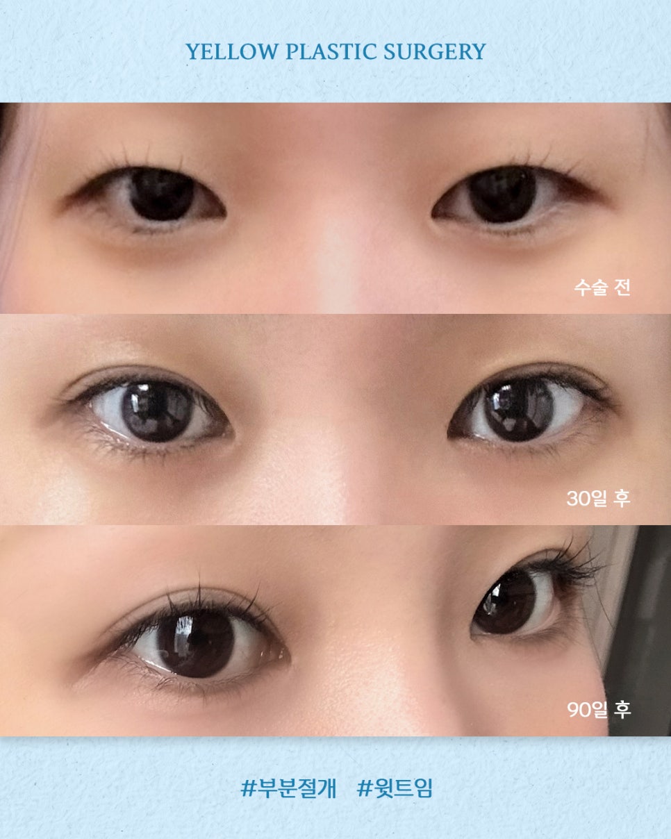 [Gangnam Station Yellow Plastic Surgery / Eye Surgery] Partial Incision + Upper Canthoplasty image 1