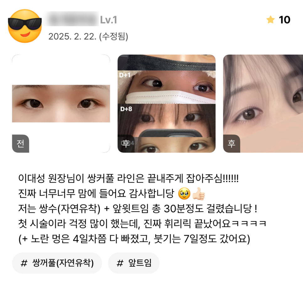 [ 강남역 옐로우성형외과 / 눈성형 ] 자연유착 앞트임 윗트임 수술 후기 관련 이미지 2