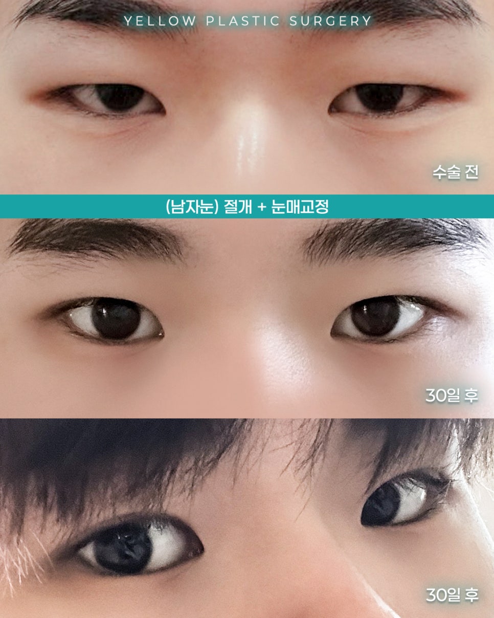 [ 강남역 옐로우성형외과 / 눈성형 ] (남자눈) 절개 + 눈매교정 관련 이미지 1