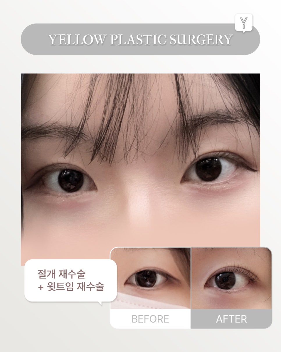 [ Gangnam Station Yellow Plastic Surgery Clinic / Eye Surgery ] Incisional Revision + Upper Canthoplasty Revision image 1