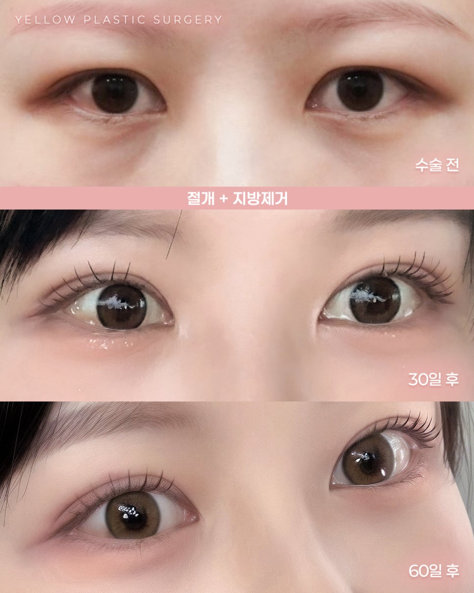[ Gangnam Station Yellow Plastic Surgery / Eye Surgery ] Incision + Fat Removal image 1