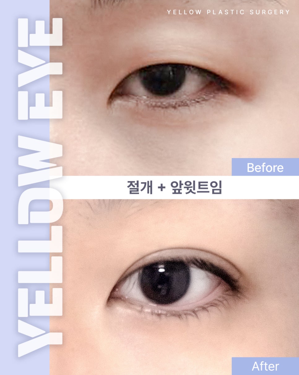 [ Gangnam Station Yellow Plastic Surgery / Eye Surgery ] Incision + Epicanthoplasty image 1