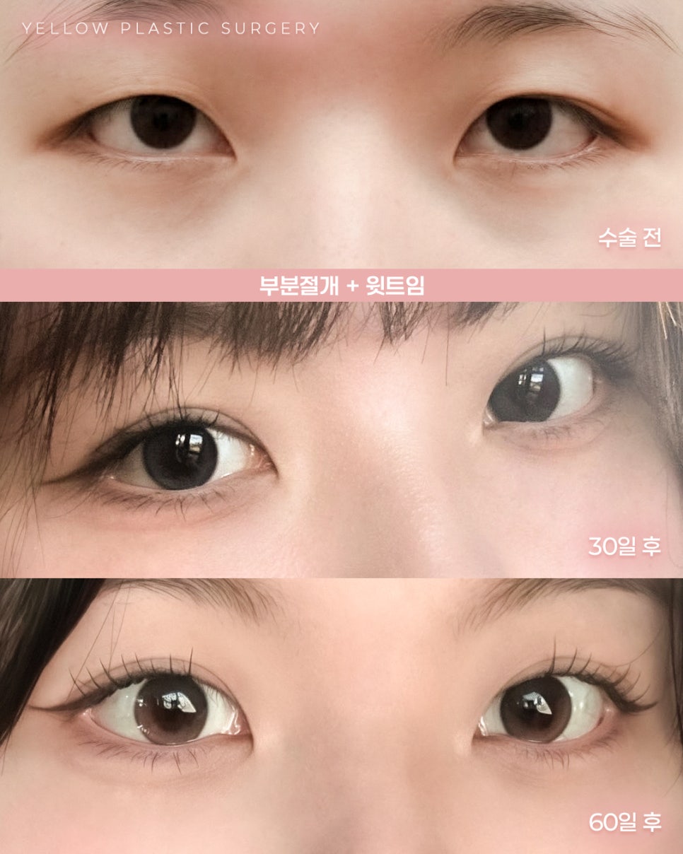 [ 강남역 옐로우성형외과 / 눈성형 ] 부분절개 + 윗트임 관련 이미지 1