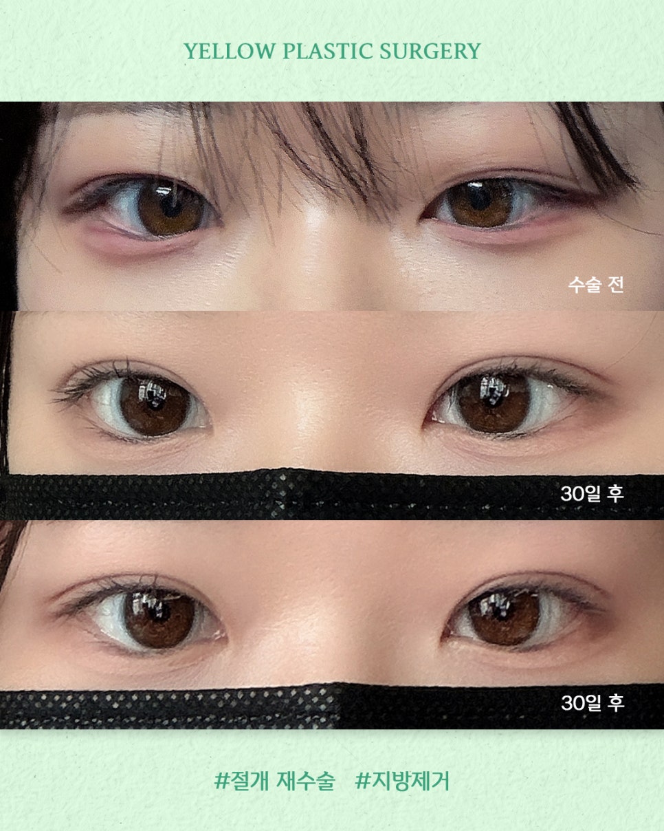 [ 강남역 옐로우성형외과 / 눈성형 ] 절개 재수술 + 지방제거 관련 이미지 1