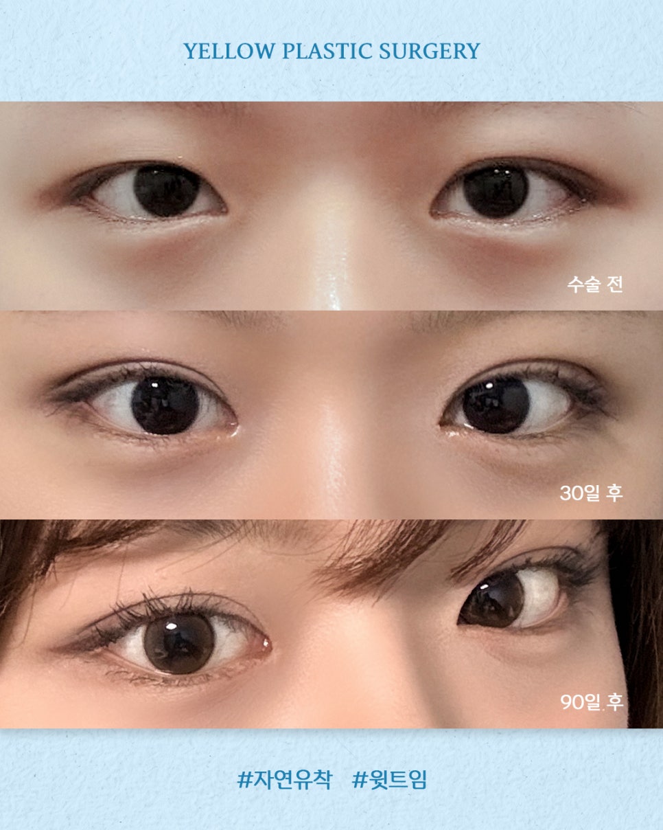 [ Gangnam Station Yellow Plastic Surgery / Eye Surgery ] Natural Adhesion + Upper Canthoplasty image 1