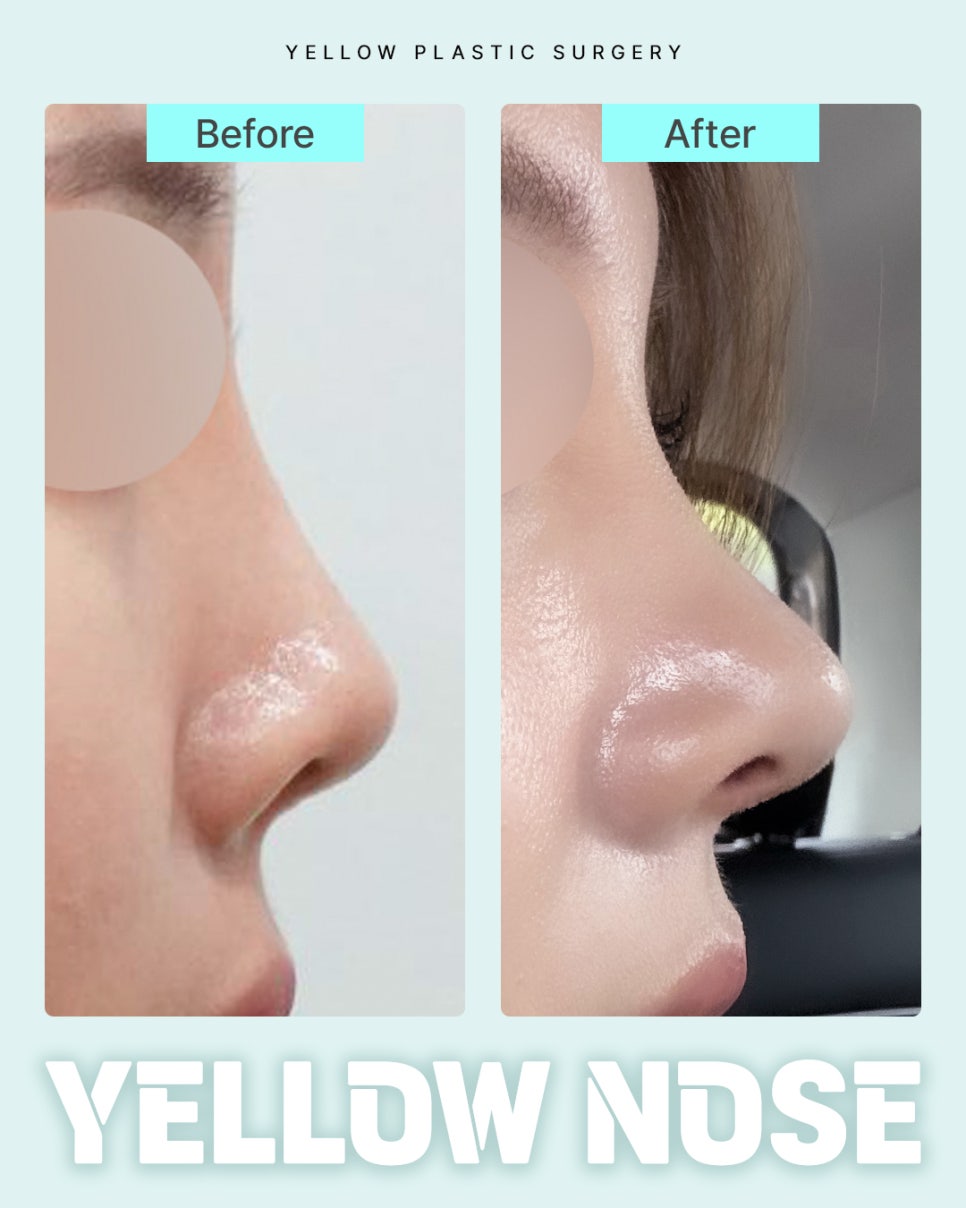 Gangnam Station Yellow Plastic Surgery / Rhinoplasty image 1