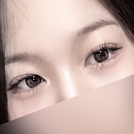 [ 강남역 옐로우성형외과 / 눈성형 ] 자연유착 윗트임 수술 후기 관련 이미지 3