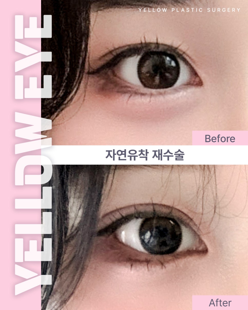 [ 강남역 옐로우성형외과 / 눈성형 ] 자연유착 재수술 관련 이미지 1