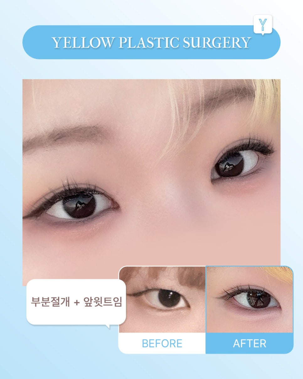 [ Gangnam Station Yellow Plastic Surgery / Eye Surgery ] Partial Incision + Inner Upper Epicanthoplasty image 1