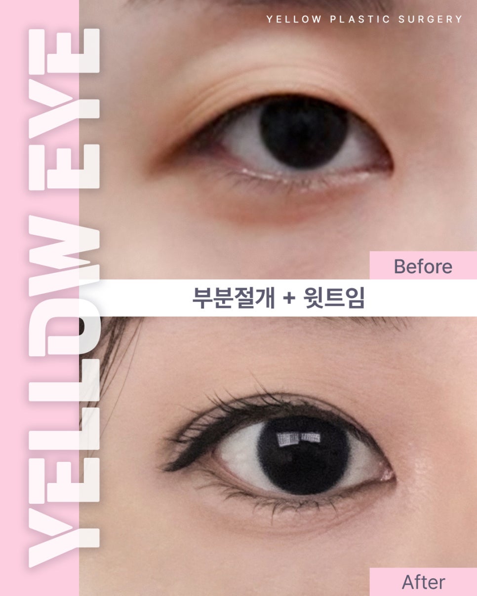 [ Gangnam Station Yellow Plastic Surgery / Eye Surgery ] Partial Incision + Upper Eyelid Incision image 1