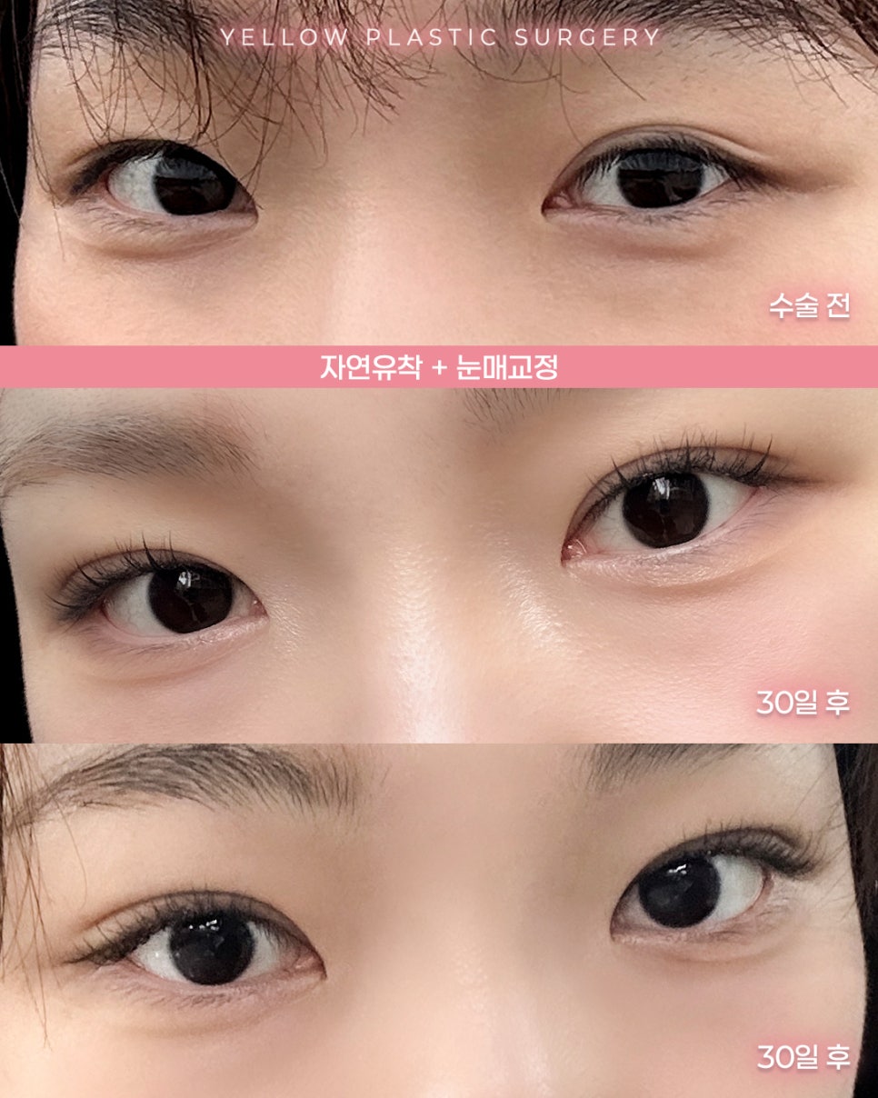 [ Gangnam Station Yellow Plastic Surgery / Eye Surgery ] Natural Adhesion + Ptosis Correction image 1
