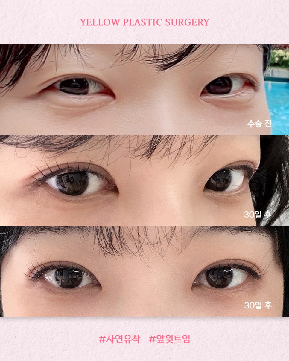 [ 강남역 옐로우성형외과 / 눈성형 ] 자연유착 + 앞윗트임 관련 이미지 1