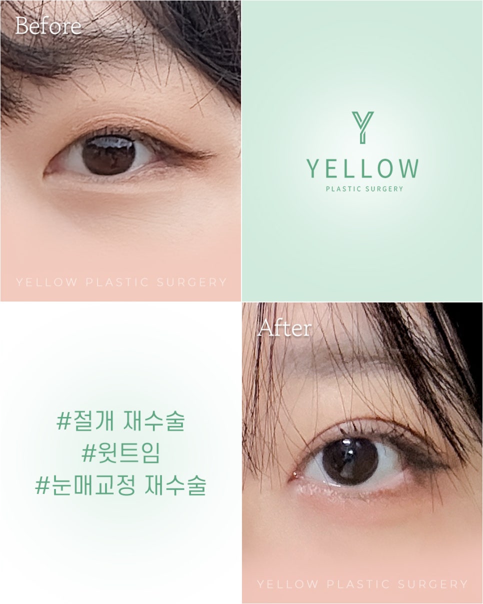 [ Gangnam Station Yellow Plastic Surgery / Eye Surgery ] Incisional Revision Surgery + Upper Epicanthoplasty + Revision Ptosis Correction image 1