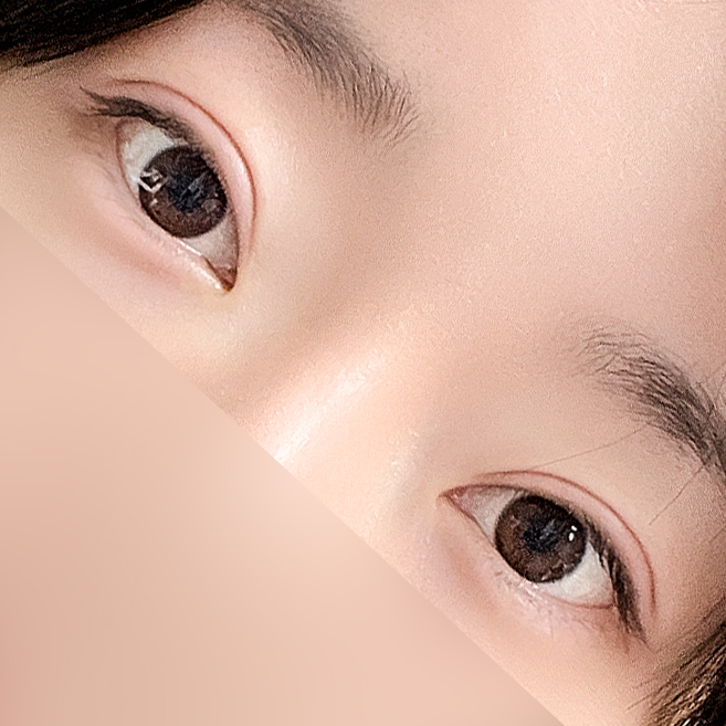[Gangnam Station Yellow Plastic Surgery / Eye Surgery] Seven-Month Review After First Partial Incision Surgery: Improvement in Uneven Eyes image 11