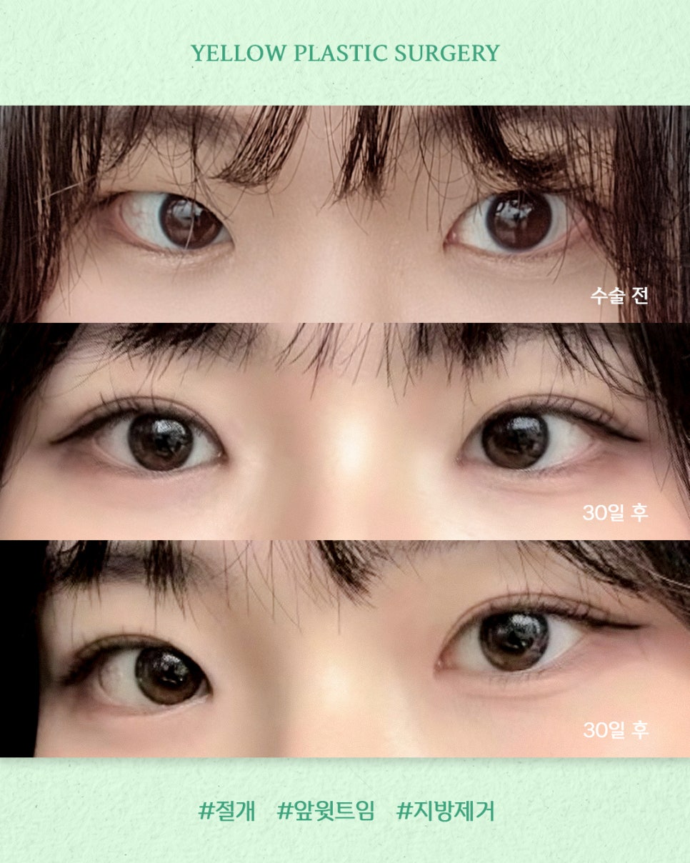 [ Gangnam Station Yellow Plastic Surgery Clinic / Eye Surgery ] Incisional Double Eyelid Surgery + Upper Inner Canthoplasty + Fat Removal image 1