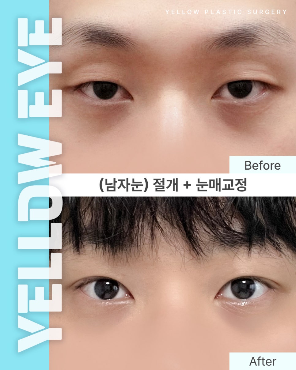 [ Gangnam Station Yellow Plastic Surgery Clinic / Eye Plastic Surgery ] (Men's Eyes) Incision + Eye-Shape Correction image 1