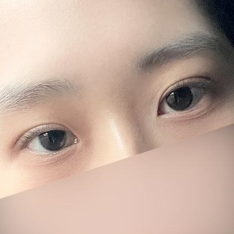 [ 강남역 옐로우성형외과 / 눈성형 ]  자연유착 눈수술 쌍수 후기 관련 이미지 3