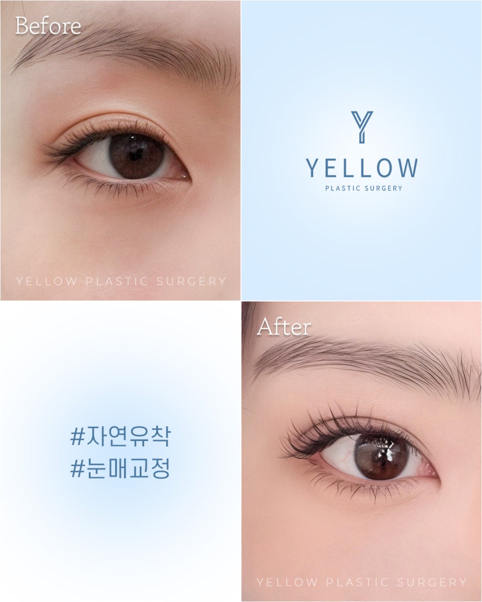 [ 강남역 옐로우성형외과 / 눈성형 ] 자연유착 + 눈매교정 관련 이미지 1