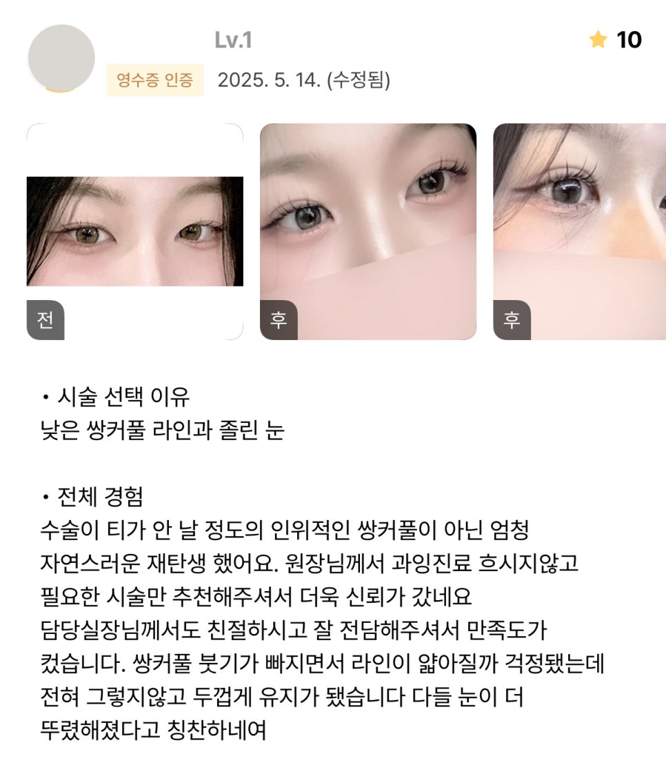 [ 강남역 옐로우성형외과 / 눈성형 ] 자연유착 윗트임 수술 후기 관련 이미지 2
