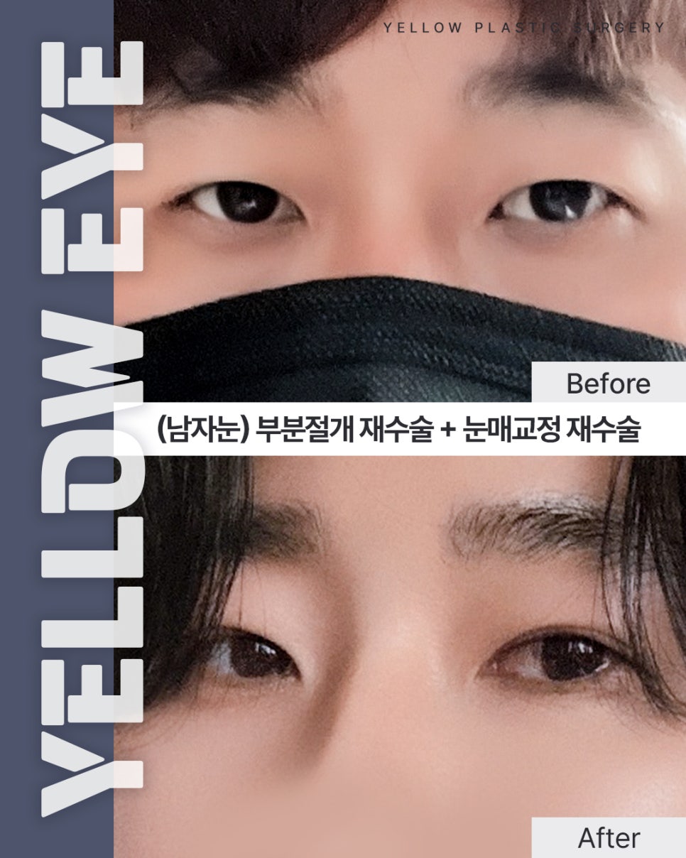 [ Gangnam Station Yellow Plastic Surgery / Eye Surgery ] (Male Eyes) Revision Partial-Incision Double Eyelid Surgery + Revision Eye Shape Correction image 1