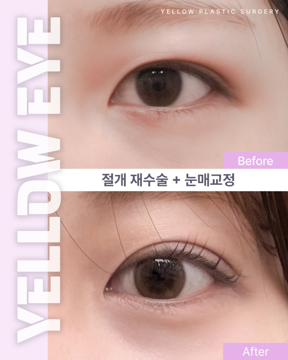 [ 강남역 옐로우성형외과 / 눈성형 ] 절개 재수술 + 눈매교정 관련 이미지 1