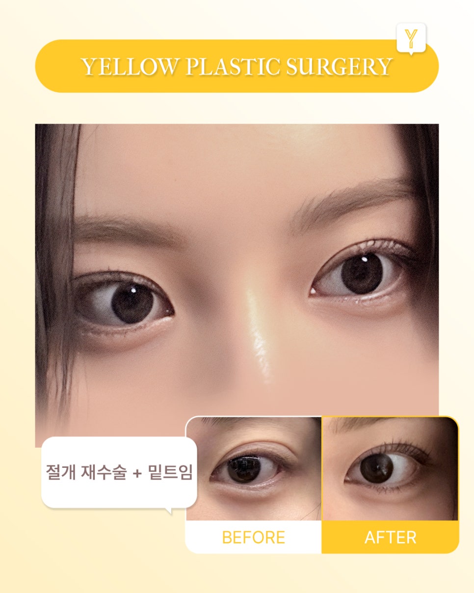[ Gangnam Station Yellow Plastic Surgery Clinic / Eye Plastic Surgery ] Incisional Revision Surgery + Lower Canthoplasty image 1