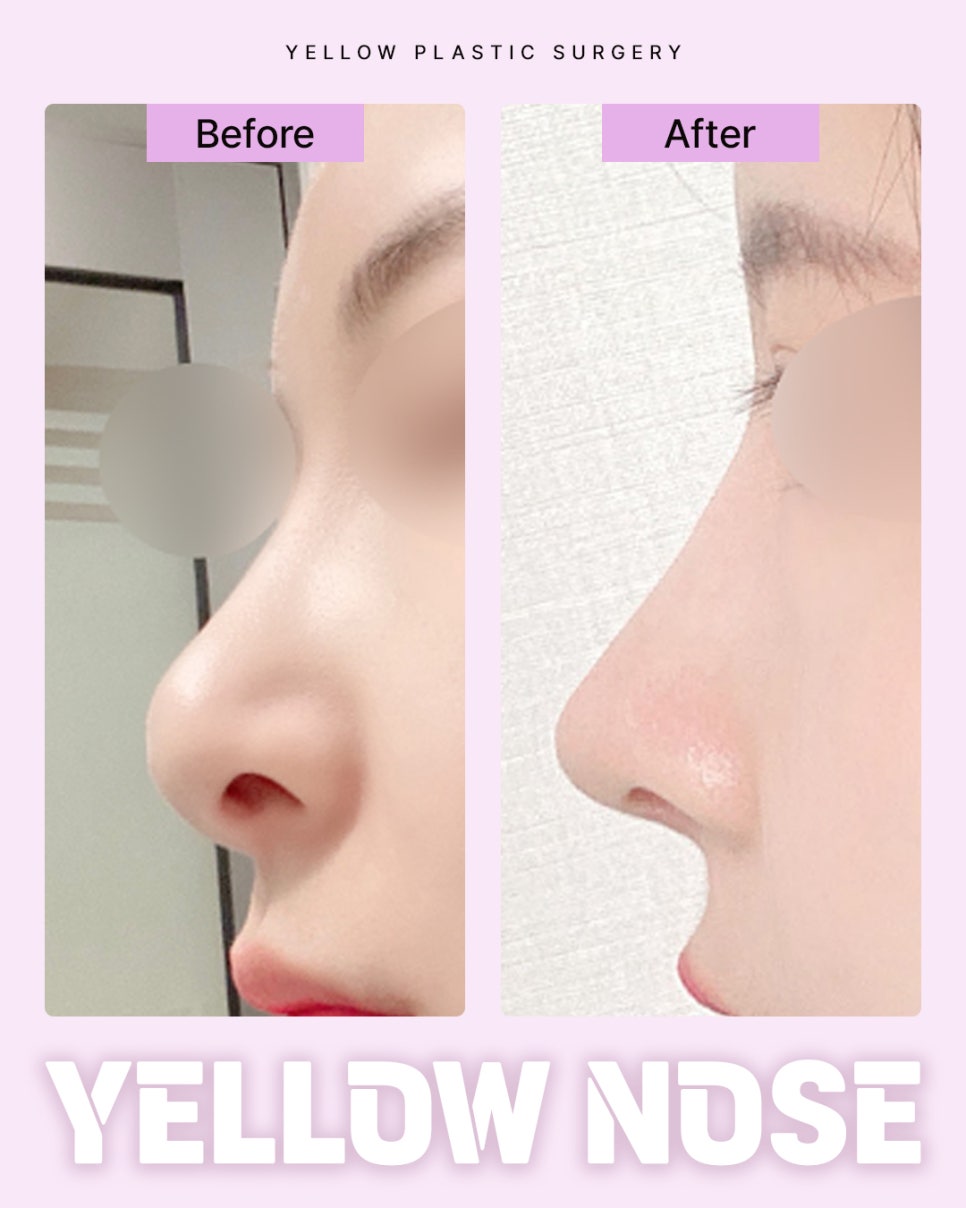 Gangnam Station Yellow Plastic Surgery / Rhinoplasty image 1