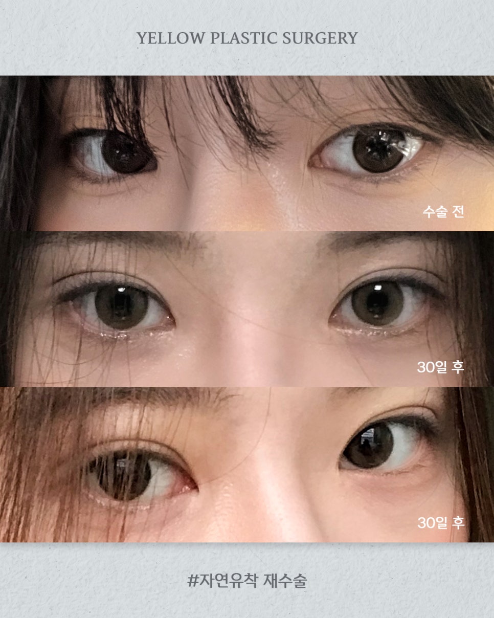[ 강남역 옐로우성형외과 / 눈성형 ] 자연유착 재수술 관련 이미지 1