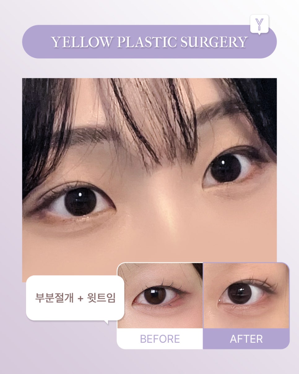 [ Gangnam Station Yellow Plastic Surgery / Eye Surgery ] Partial Incision + Upper Canthoplasty image 1