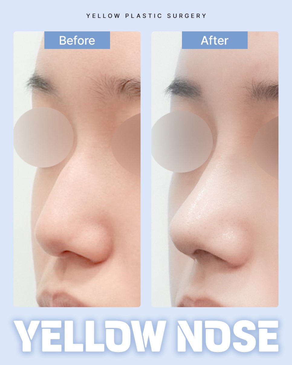 Gangnam Station Yellow Plastic Surgery / Rhinoplasty image 1