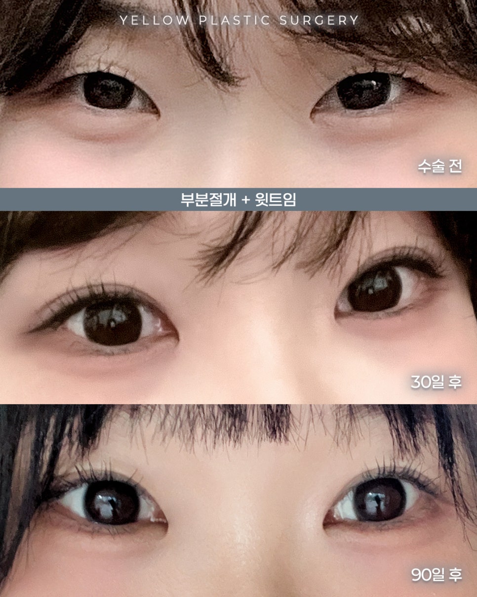 [ 강남역 옐로우성형외과 / 눈성형 ] 부분절개 + 윗트임 관련 이미지 1