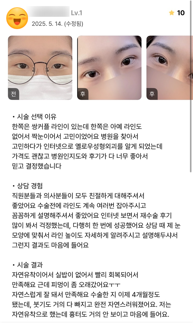 [ 강남역 옐로우성형외과 / 눈성형 ]  자연유착 눈수술 쌍수 후기 관련 이미지 2