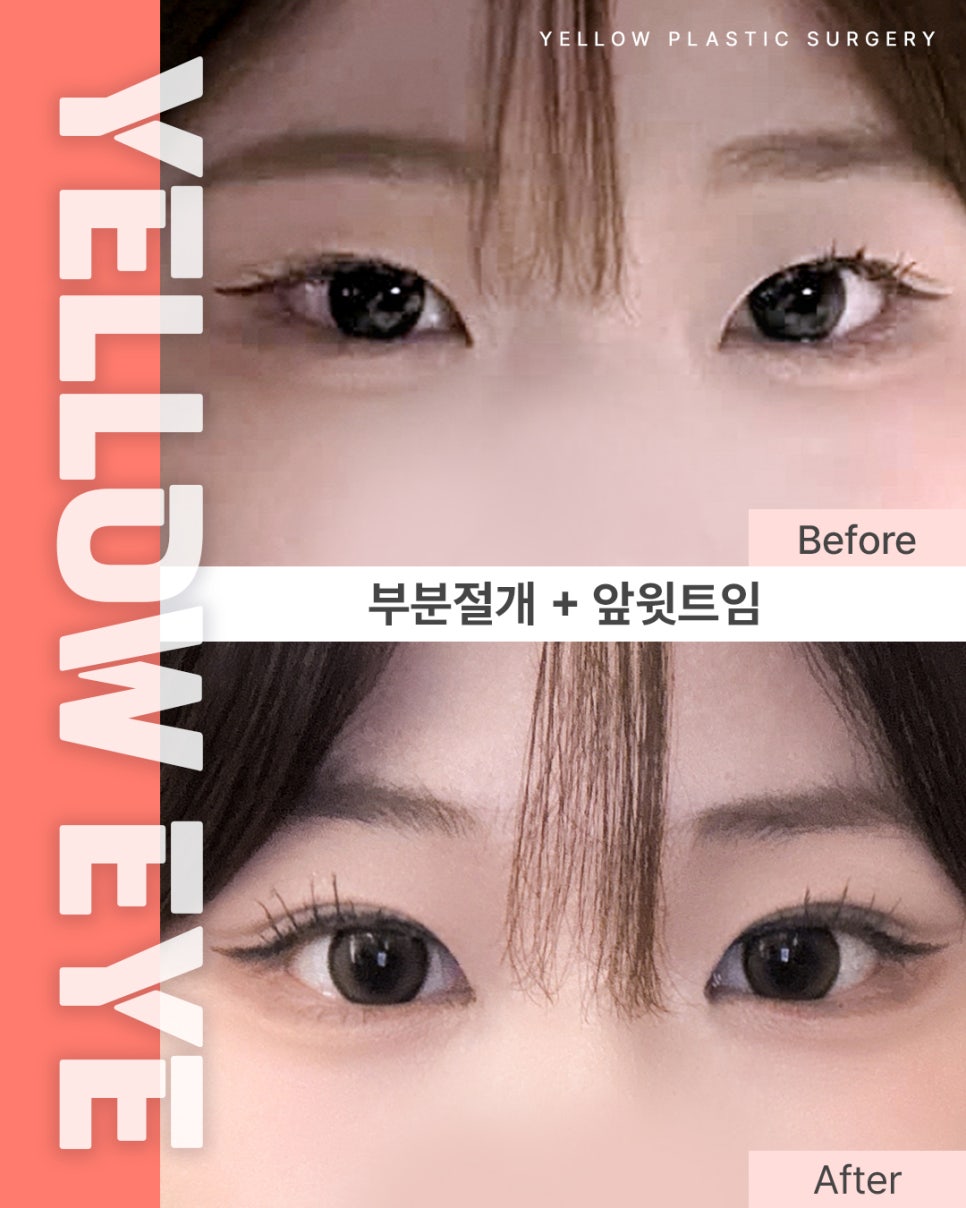 [ 강남역 옐로우성형외과 / 눈성형 ] 부분절개 + 앞윗트임 관련 이미지 1