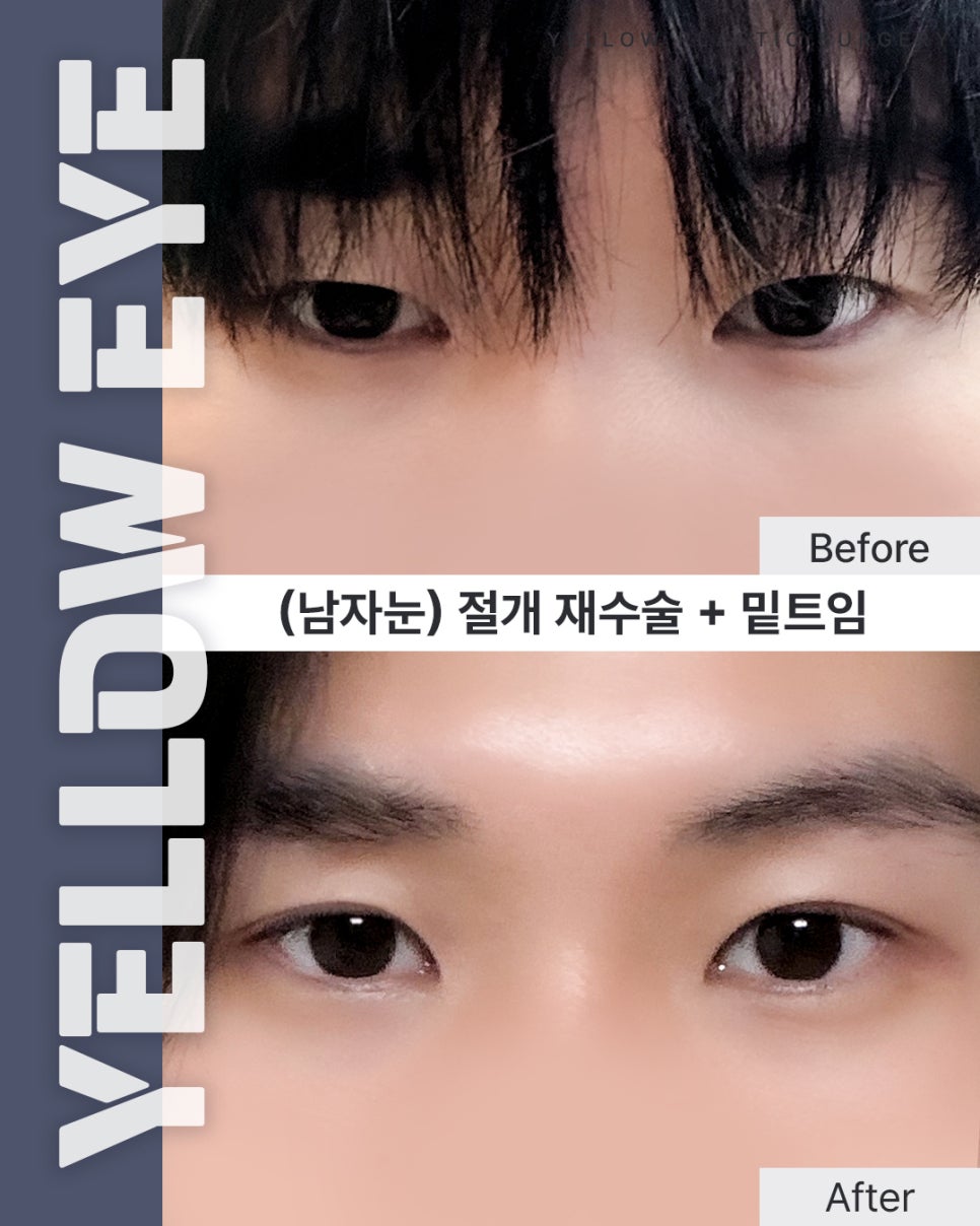 [ Gangnam Station Yellow Plastic Surgery Clinic / Eye Surgery ] (Male Eyes) Incisional Revision Surgery + Lower Canthoplasty image 1