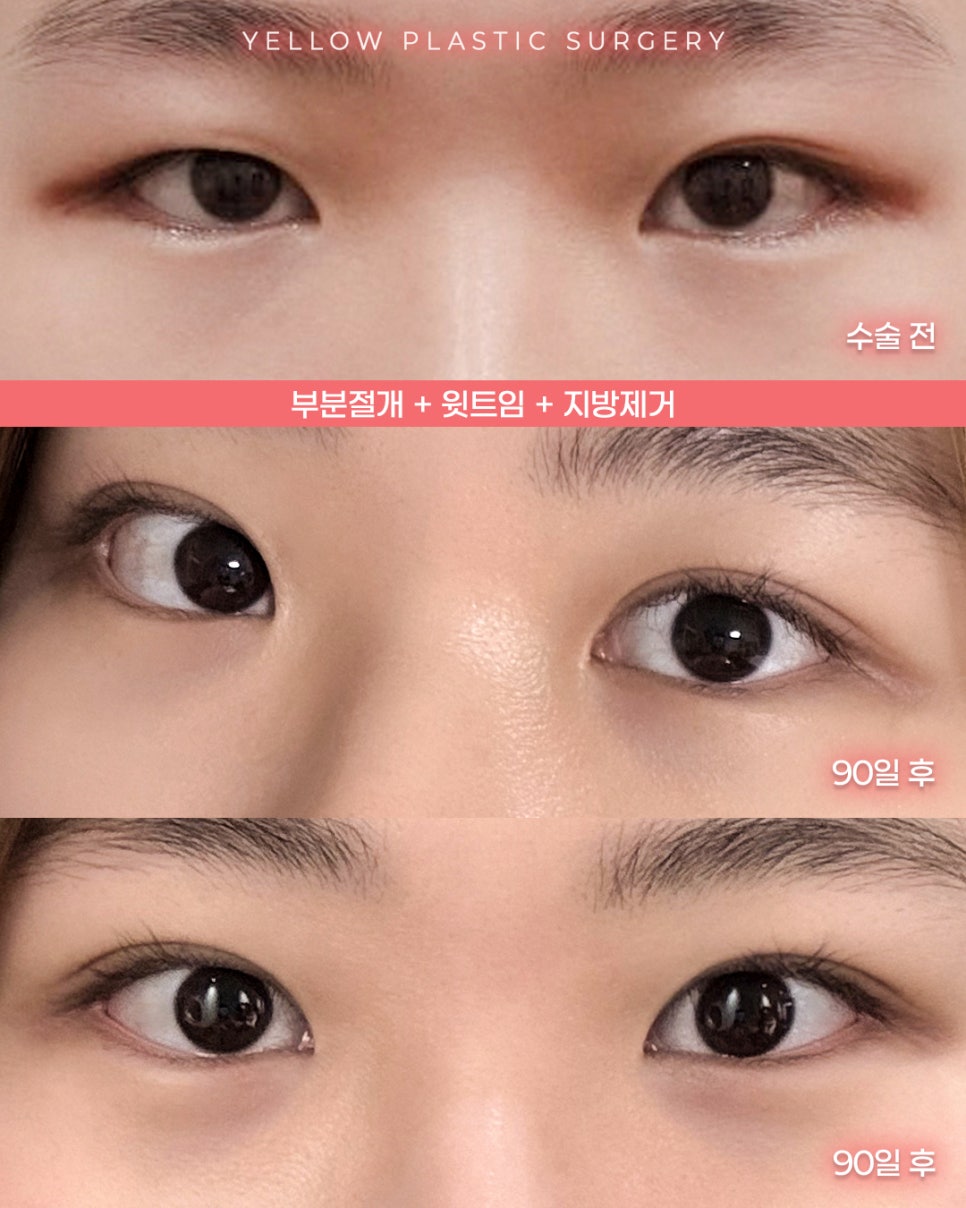 [ Gangnam Station Yellow Plastic Surgery / Eye Surgery ] Partial Incision + Upper Epicanthoplasty + Fat Removal image 1