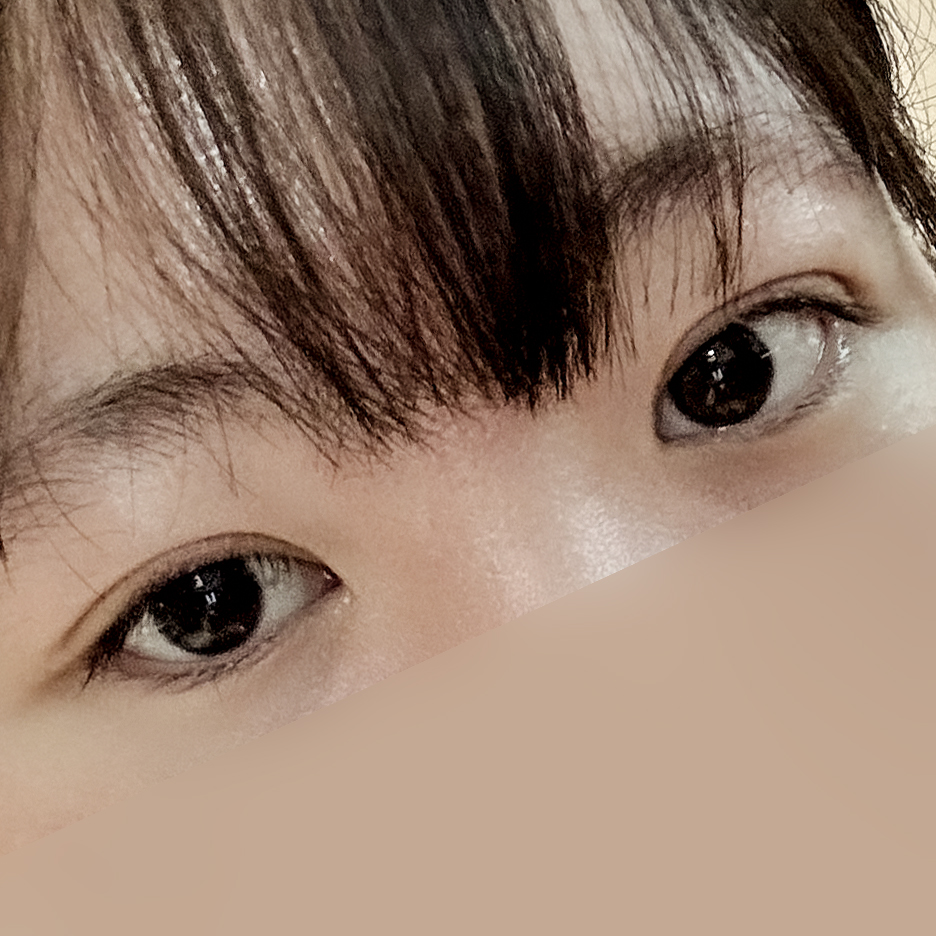 [ 강남역 옐로우성형외과 / 눈성형 ]  부분절개 앞트임 윗트임 수술 후기 2개월차 4개월차 관련 이미지 9